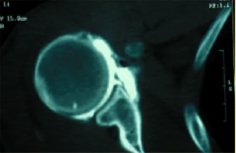 Douleurs épaule, arthroscanner