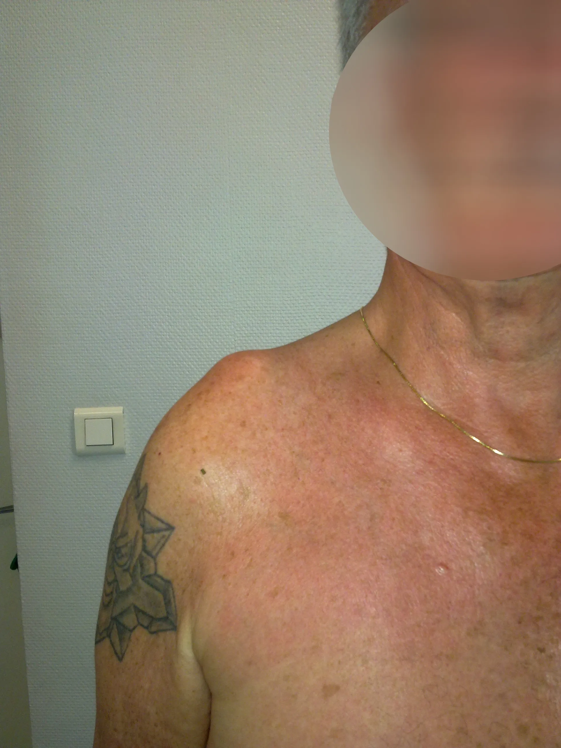 Arm pain, treatments