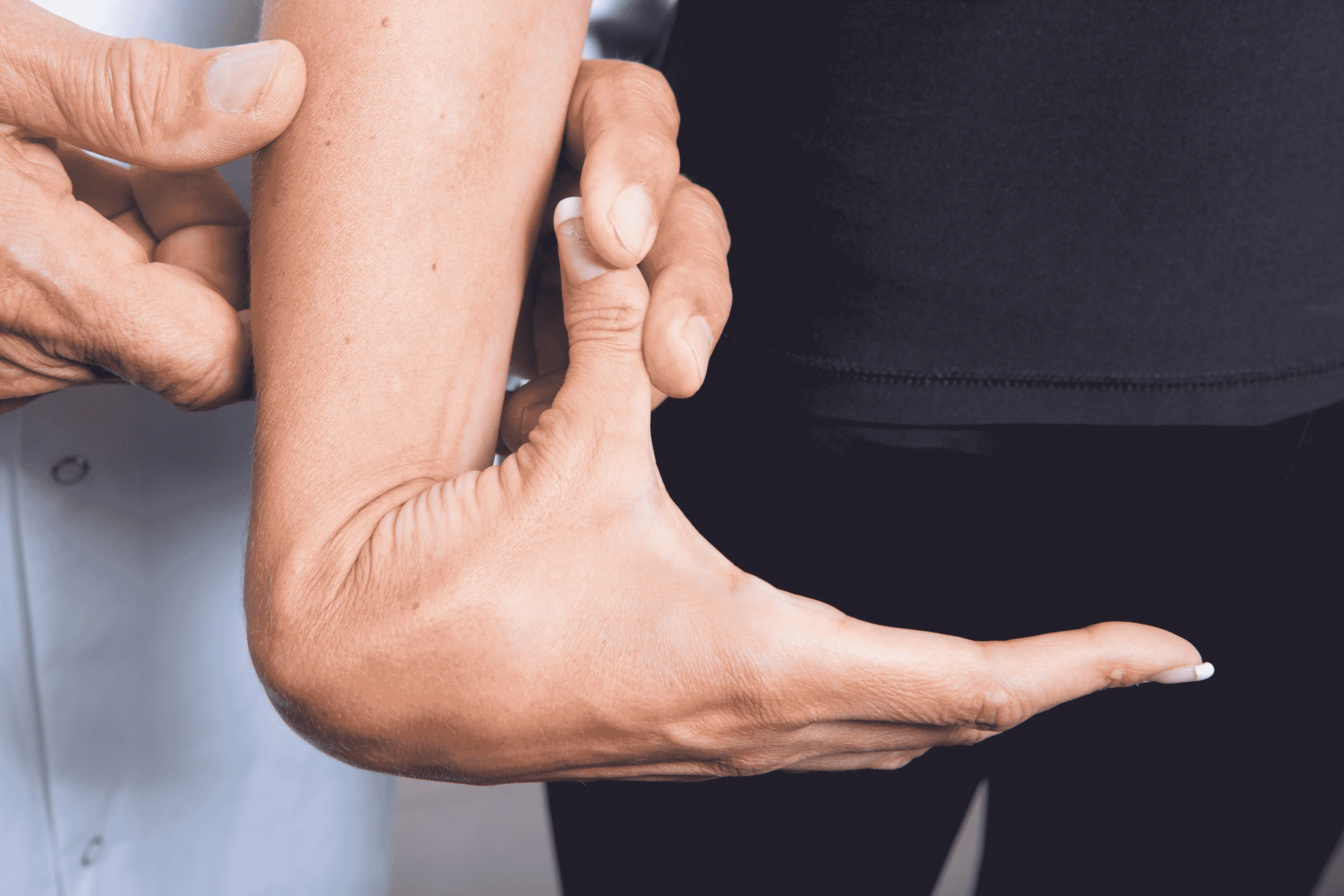 Ligamentous hyperlaxity