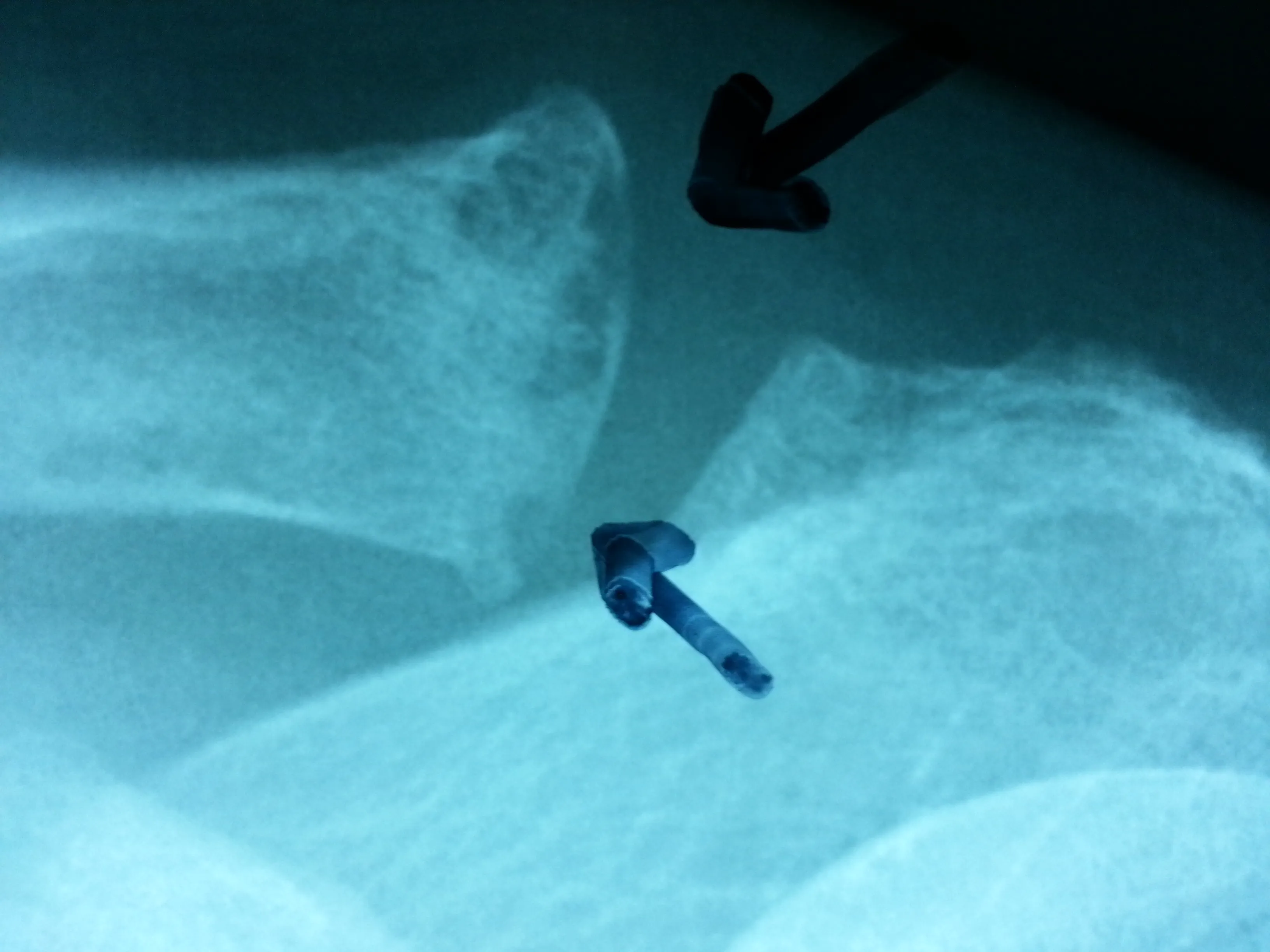 Radiographie acromio-claviculaire