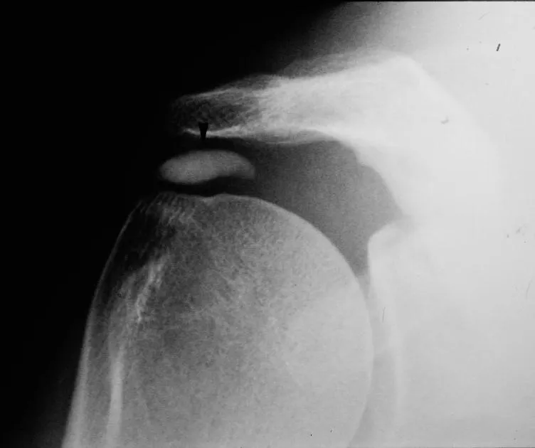 Radiographie épaule, calcification